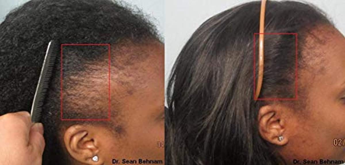 Black Seed Oil for powerful Hair growth - Thick and Full