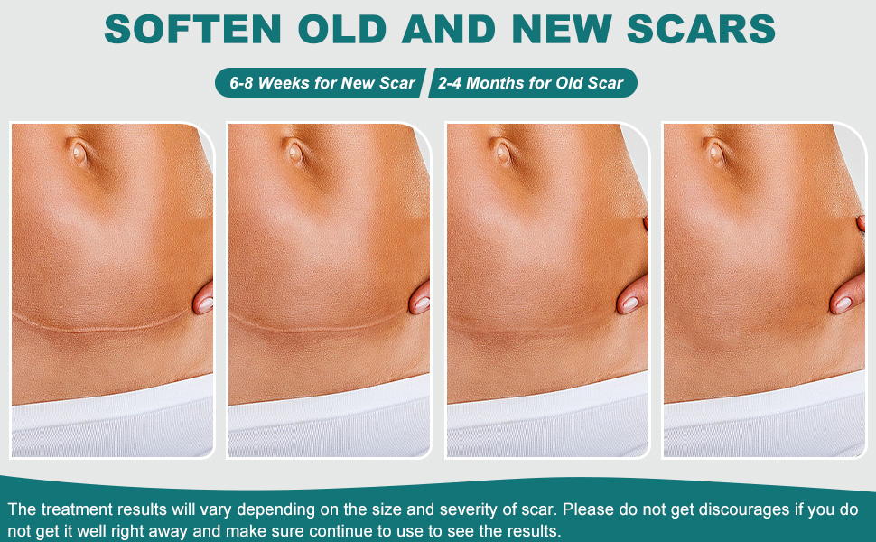 silicone scar sheets