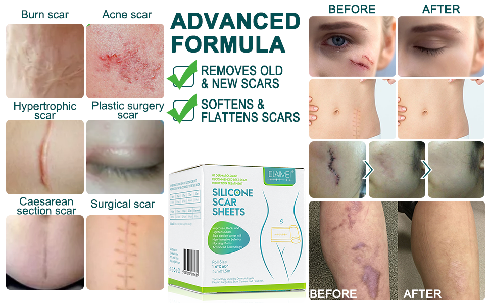 Silicone Scar Sheets Benefits