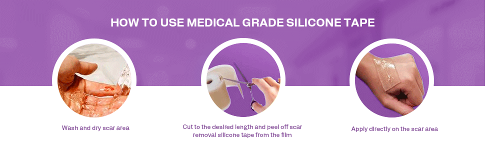 Silicone Scar Sheets