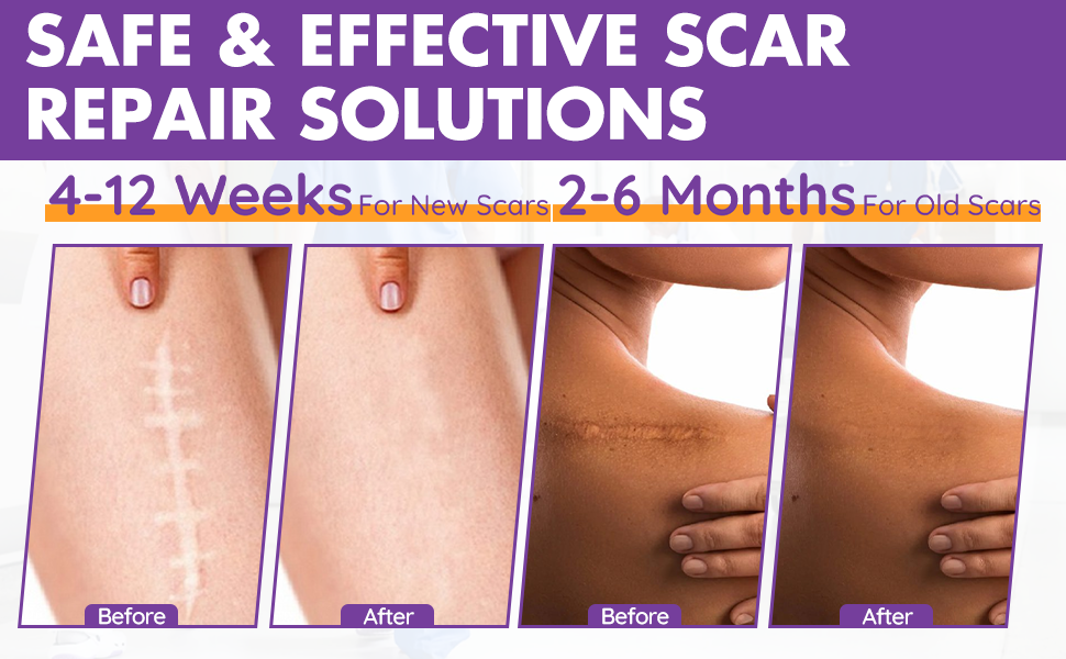 silicone scar tape for many kinds of scar