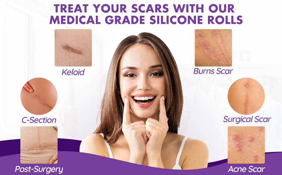 silicone scar tape