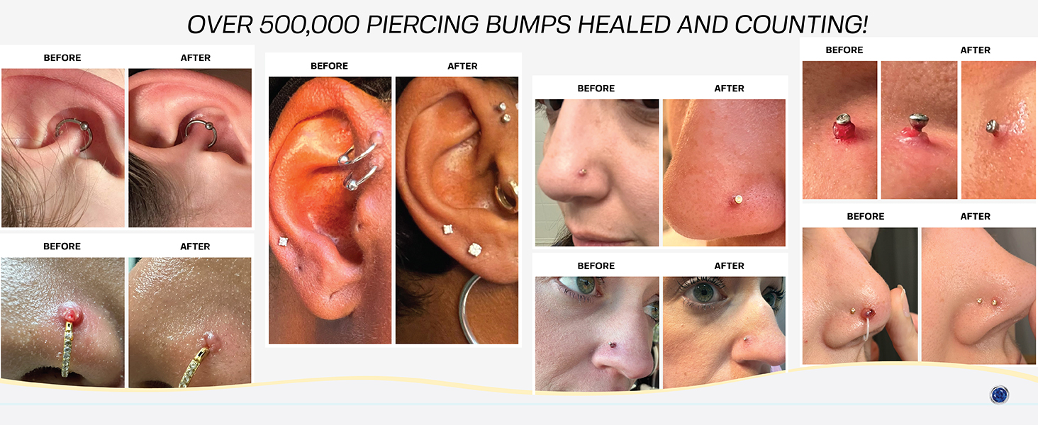 keloid bump removal