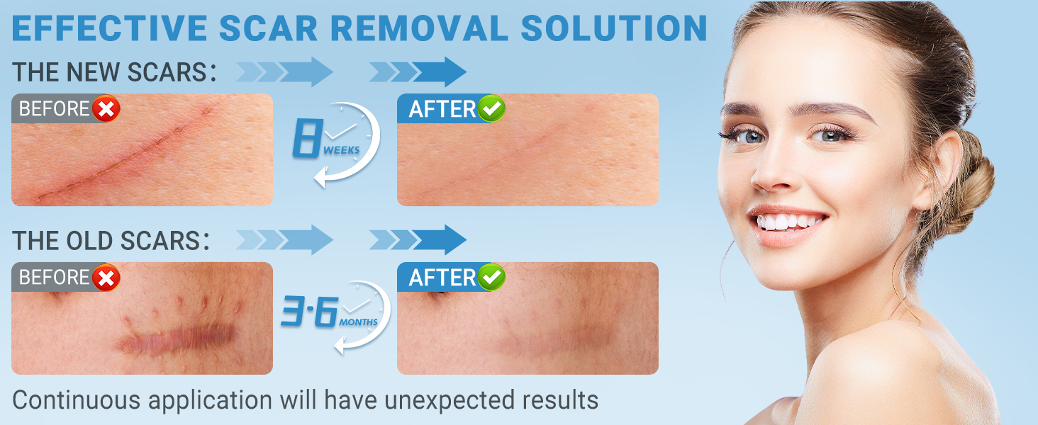 silicone scar gel example