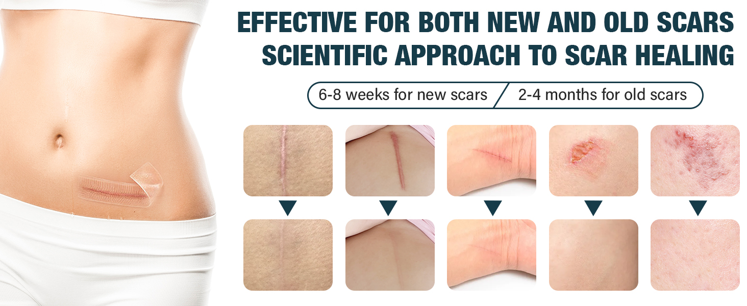 silicone scar sheets