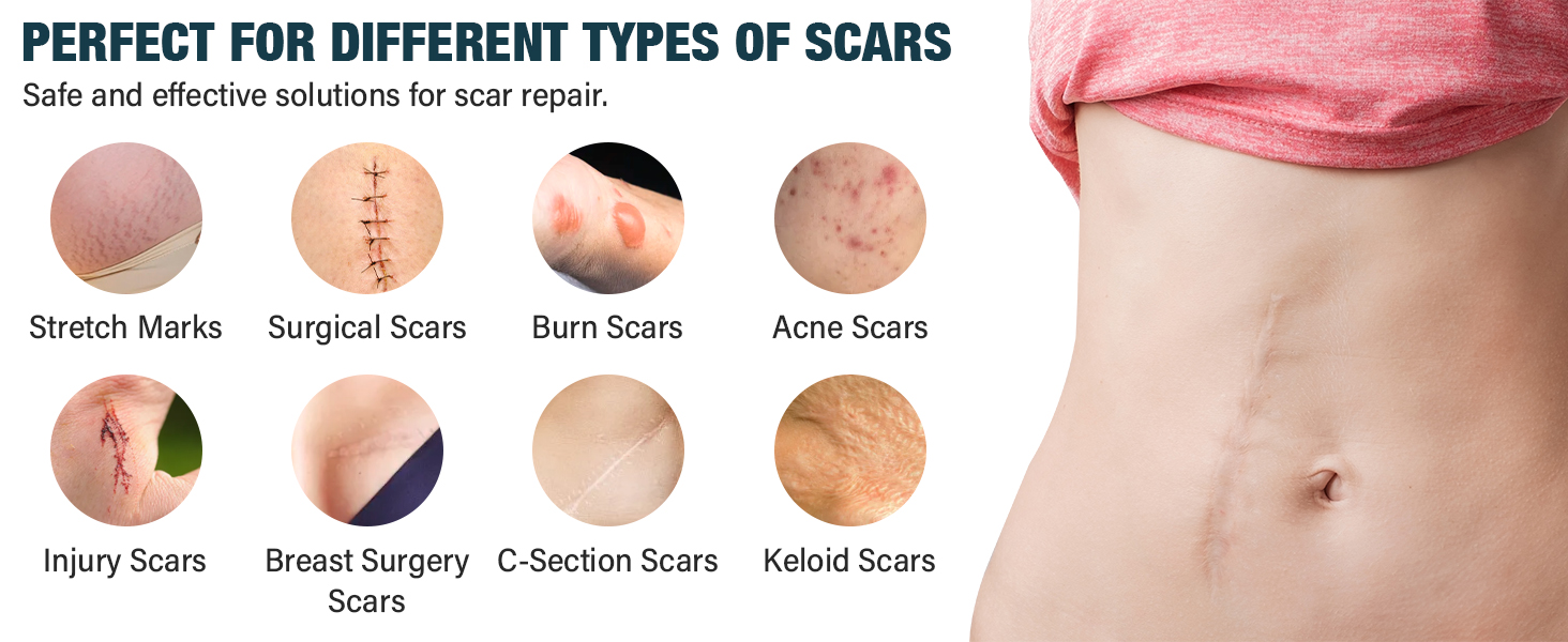silicone scar sheets